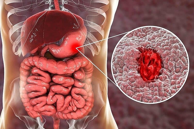 Cần chữa trị ngay khi bị chảy máu đường tiêu hóa