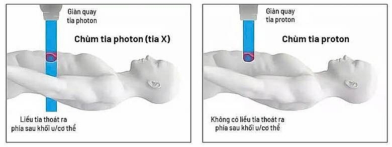 Xạ trị photon (tia X) đưa liều xạ vào khối u nhưng có thể “đi xuyên qua” phía sau, tăng nguy cơ tổn thương mô lành quanh đường đi của tia; trong khi đó xạ trị proton hiện đại với tia năng lượng biết “dừng đúng chỗ” ngay vị trí khối u để tiêu diệt khối u hiệu quả và an toàn cao. Xạ trị photon (tia X) đưa liều xạ vào khối u nhưng có thể “đi xuyên qua” phía sau, tăng nguy cơ tổn thương mô lành quanh đường đi của tia; trong khi đó xạ trị proton hiện đại với tia năng lượng biết “dừng đúng chỗ” ngay vị trí khối u để tiêu diệt khối u hiệu quả và an toàn cao.