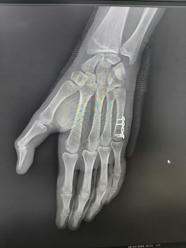 Một ca phấu thuật Boxer’s Fracture tại Bệnh viện Đại học Y Dược cơ sở Linh Đàm, Hà Nội