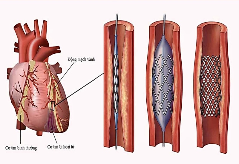 Đặt sten động mạch vành giúp bệnh nhân tái thông dòng máu nuôi tim Đặt sten động mạch vành giúp bệnh nhân tái thông dòng máu nuôi tim