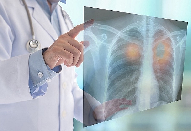 Tầm soát ung thư phổi là hoạt động nên được tiến hành định kỳ Ung thư phổi vẫn là một trong những nguyên nhân gây tử vong hàng đầu