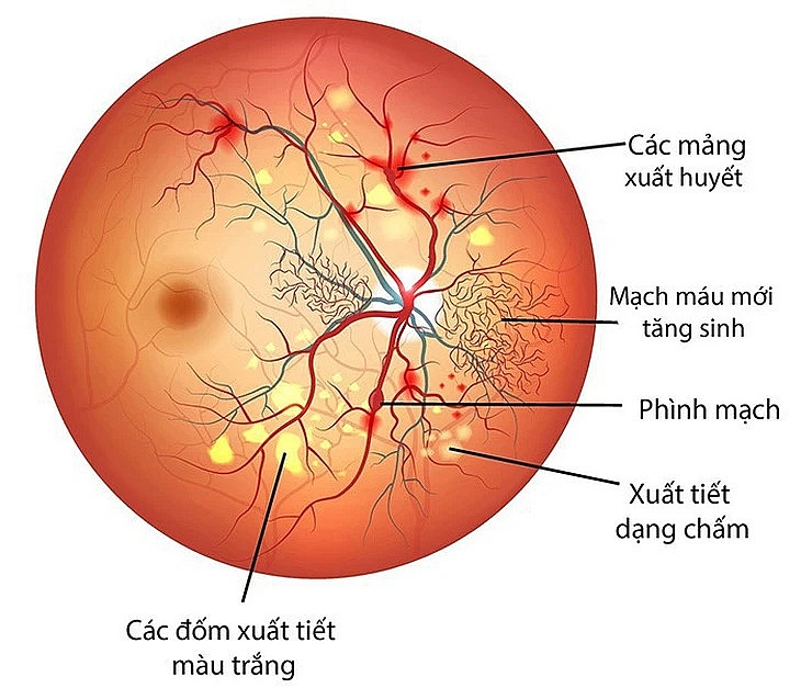 Người bệnh đái tháo đường cần chụp đáy mắt ít nhất 1 lần/năm Người bệnh đái tháo đường cần chụp đáy mắt ít nhất 1 lần/năm
