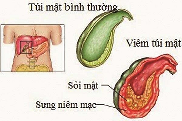 Hình ảnh minh họa sỏi mật Hình ảnh minh họa sỏi mật