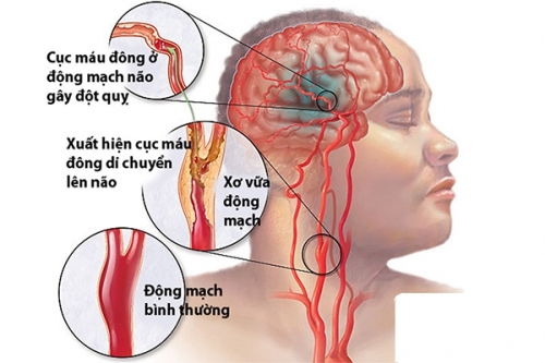 Chủ động phòng đột qụy não