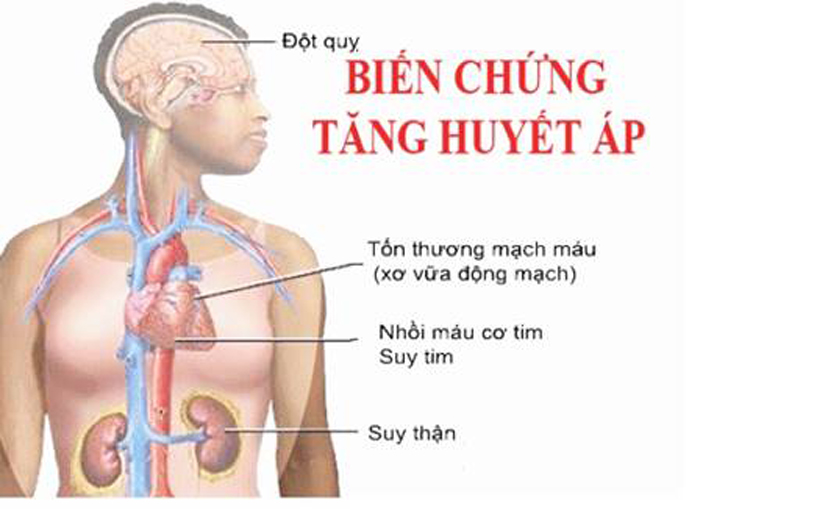 C&aacute;c biến chứng của tăng huyết &aacute;p.