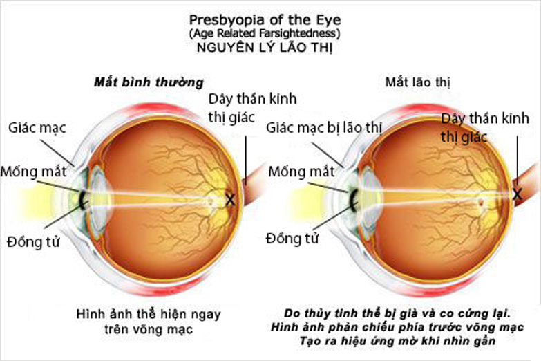 Tuổi ng&agrave;y c&agrave;ng cao, thủy tinh thể tự nhi&ecirc;n trong mắt bị cứng dần sẽ g&acirc;y ra hiện tượng l&atilde;o thị.