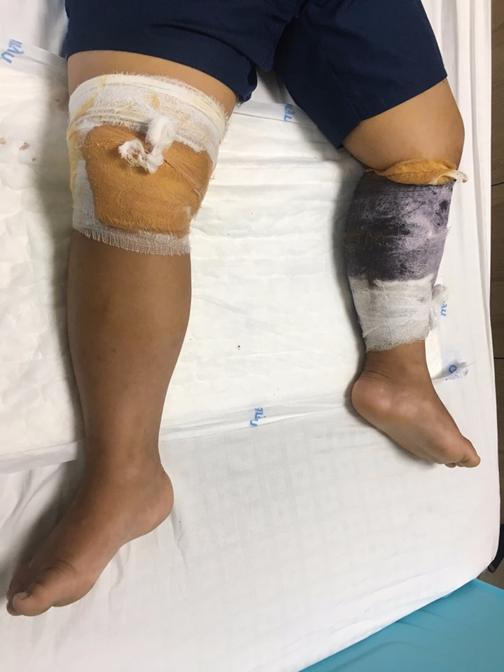 Phú Thọ: Cháu bé 7 tuổi bị chó cắn, phải khâu gần 70 mũi