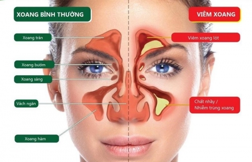 Sự nguy hiểm của bệnh viêm xoang