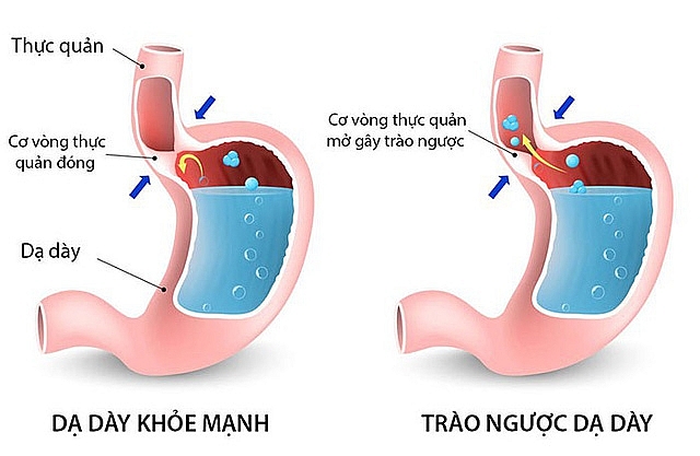 Trào ngược dạ dày thực quản là gì? Trào ngược dạ dày thực quản là gì?
