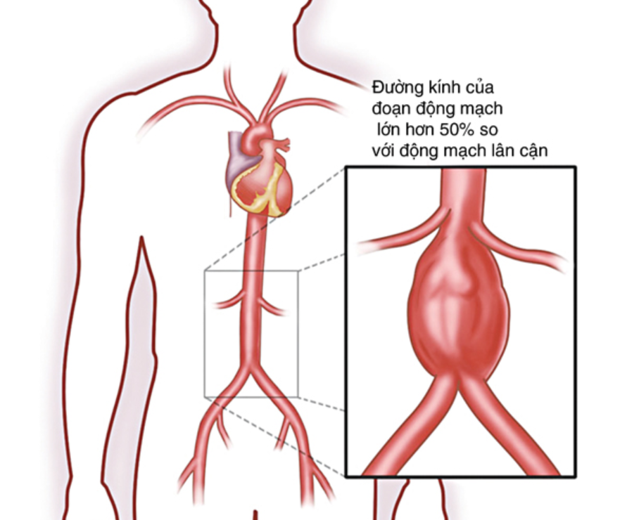 Phình động mạch chủ bụng Phình động mạch chủ bụng